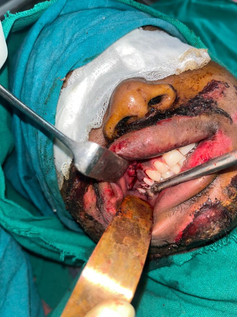 दो गंभीर जबड़ा फ्रैक्चरो को जिला अस्पताल में मिला उपचार